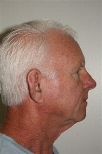 Male Facelift Patient 29 - Before - 2 Thumbnail