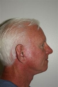 Male Facelift Patient 29 - After - 2 Thumbnail