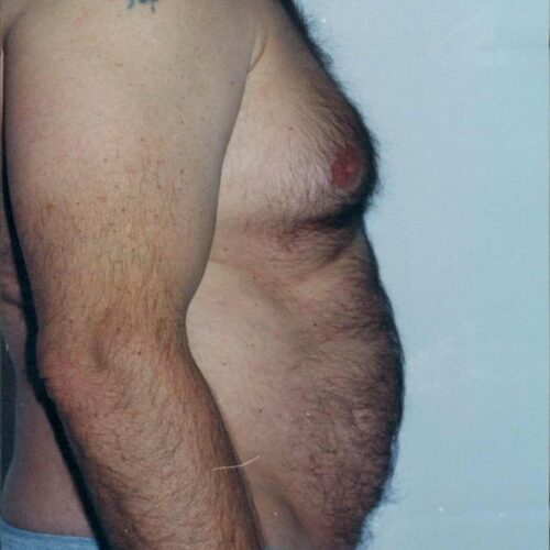 Male Liposuction Patient 08 - Before - 1