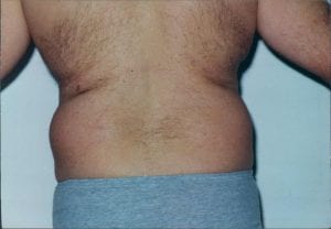 Male Liposuction Patient 08 - Before - 2 Thumbnail