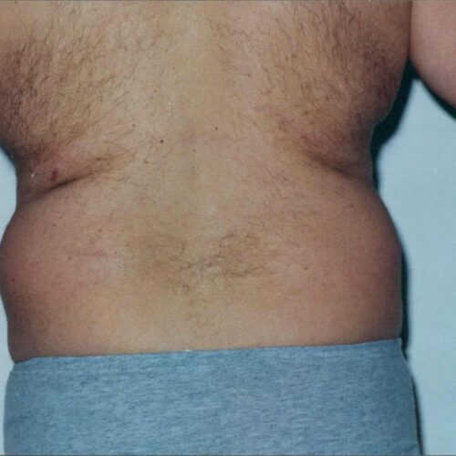 Male Liposuction Patient 08 - Before - 2