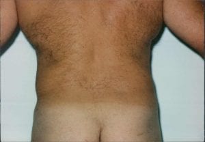 Male Liposuction Patient 08 - After - 2 Thumbnail