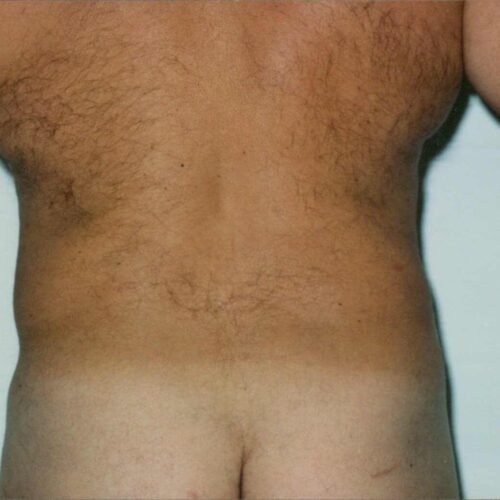 Male Liposuction Patient 08 - After - 2