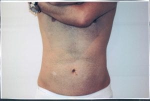 Male Liposuction Patient 05 - After - 1 Thumbnail