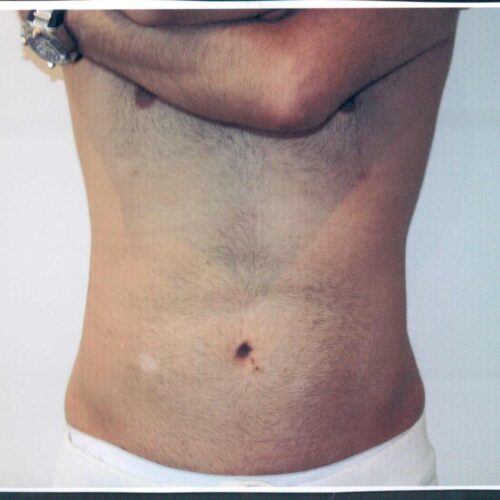 Male Liposuction Patient 05 - After - 1