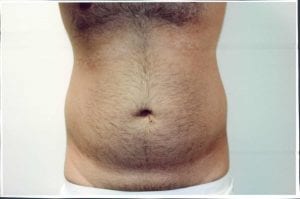 Male Liposuction Patient 05 - Before - 1 Thumbnail