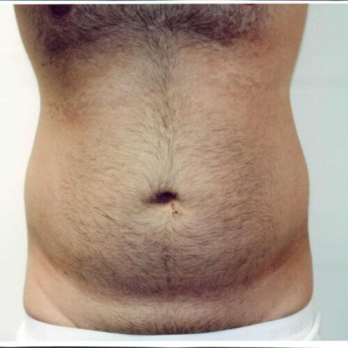 Male Liposuction Patient 05 - Before - 1