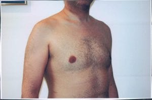 Male Liposuction Patient 05 - After - 2 Thumbnail