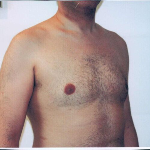 Male Liposuction Patient 05 - After - 2