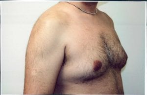Male Liposuction Patient 05 - Before - 2 Thumbnail