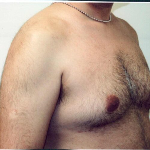Male Liposuction Patient 05 - Before - 2