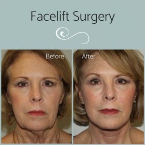 Facelift Surgery Before and After