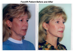 female-facelift1-00287-375x500-img-blog