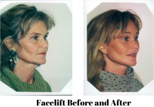 img-blog-female-facelift-1-BA