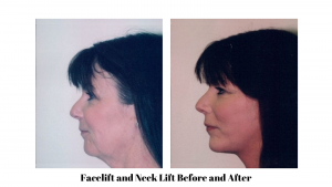 Facelift and Neck Lift Before and After