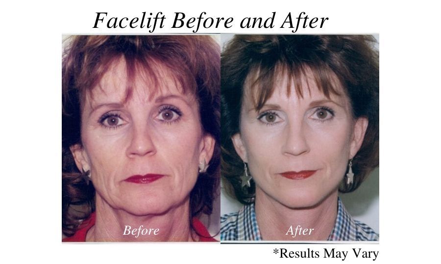 Before and after imaging showing the facelift results of a female patient performed by Dr. Ackerman in Newport Beach, California.