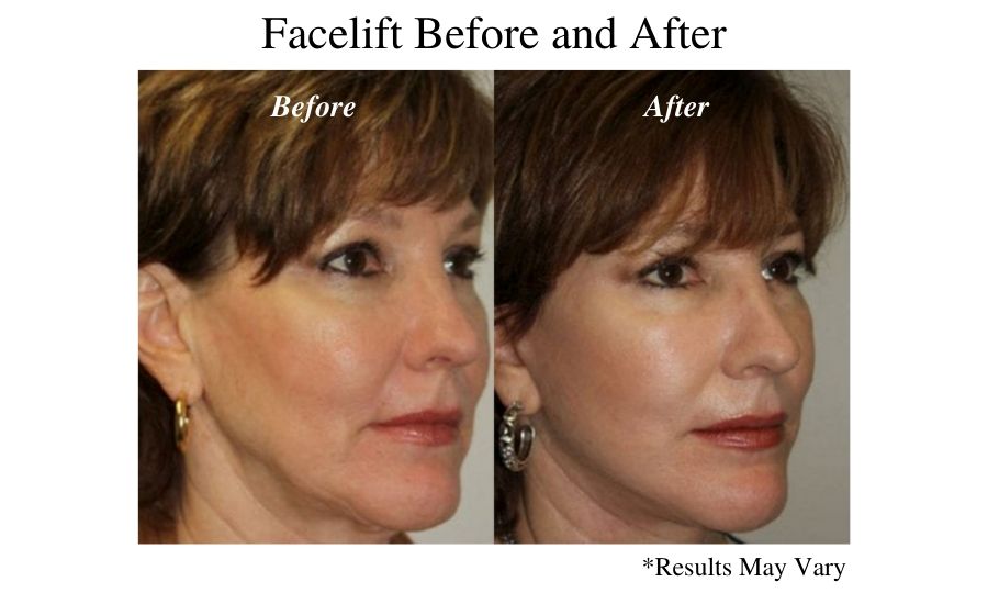 facelift before and after of a woman