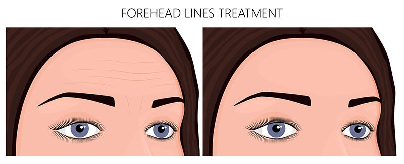 Forehead lines and wrinkles can be addressed through BOTOX cosmetic and other injectable treatments.