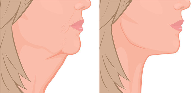Illustration of neck lift - before an after image