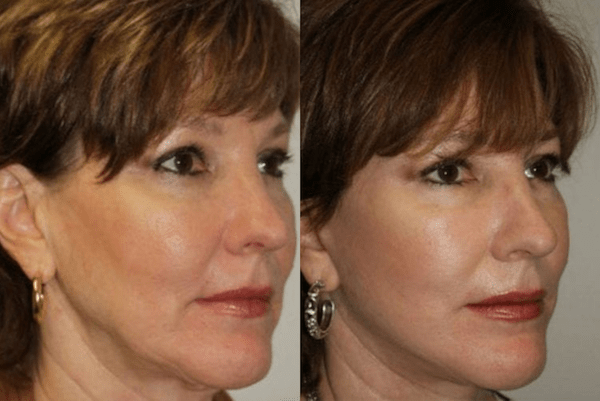 before and after facelift female facelift patient 01