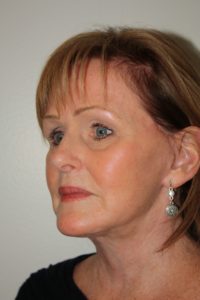 Female Facelift Patient 47 - After - 2 Thumbnail