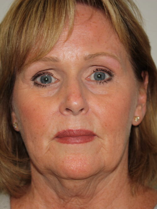 Female Facelift Patient 47 - Before - 1