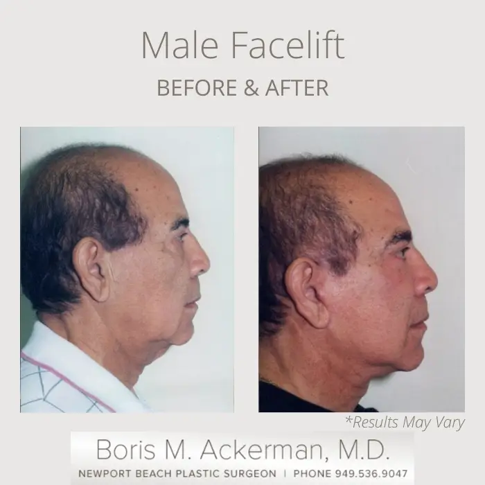before after male facelift male facelift1 00149 375x500 1