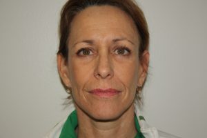 Female Facelift Patient 50 - After - 1 Thumbnail