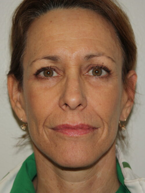 Female Facelift Patient 50 - After - 1