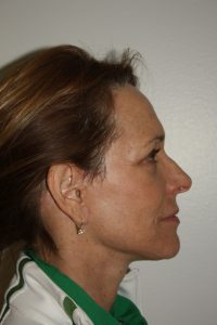 Female Facelift Patient 50 - After - 2 Thumbnail