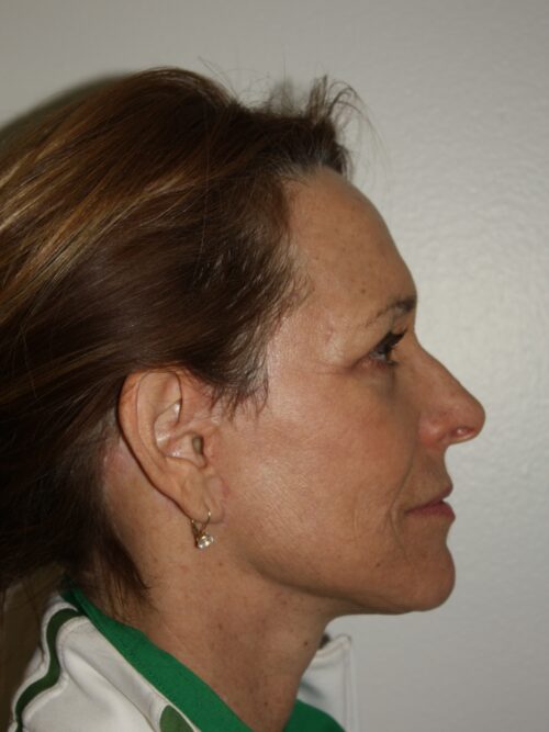 Female Facelift Patient 50 - After - 2