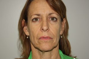 Female Facelift Patient 50 - Before - 1 Thumbnail