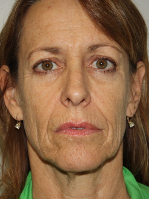 Female Facelift Patient 50 - Before - 1
