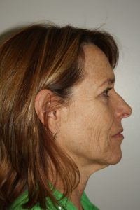 Female Facelift Patient 50 - Before - 2 Thumbnail