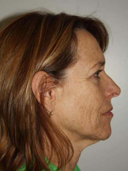 Female Facelift Patient 50 - Before - 2