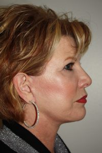 Female Facelift Patient 49 - After - 1 Thumbnail