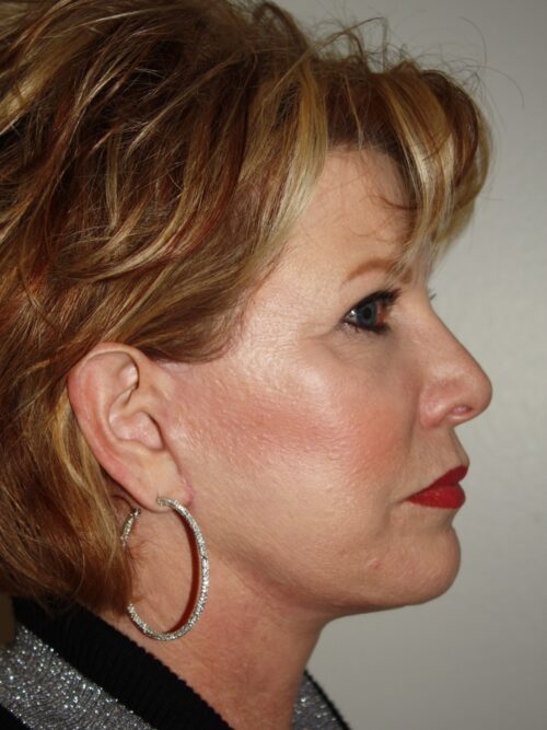 Female Facelift Patient 49 - After - 1