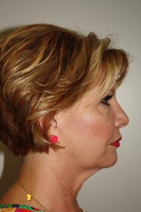 Female Facelift Patient 49 - Before - 1 Thumbnail