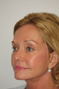 Female Facelift Patient 48 - After - 2 Thumbnail