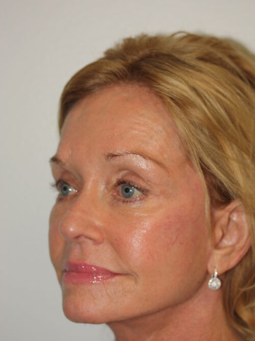 Female Facelift Patient 48 - After - 2