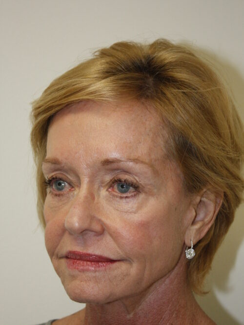 Female Facelift Patient 48 - Before - 2