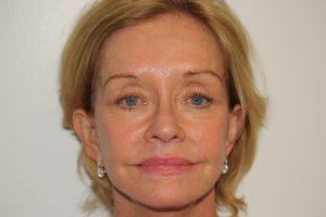 Female Facelift Patient 48 - After - 1 Thumbnail