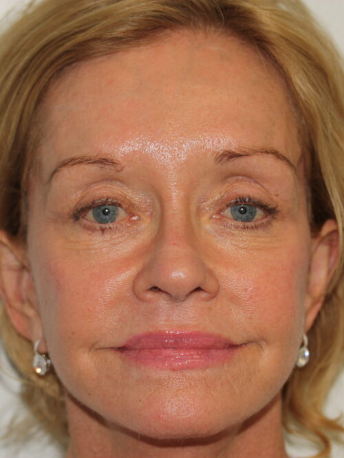 Female Facelift Patient 48 - After - 1