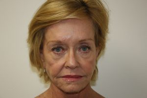 Female Facelift Patient 48 - Before - 1 Thumbnail