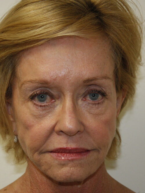 Female Facelift Patient 48 - Before - 1