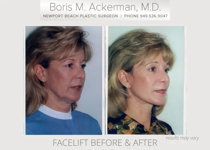 Before and after image showing the results of a facelift performed in Beverly Hills, CA