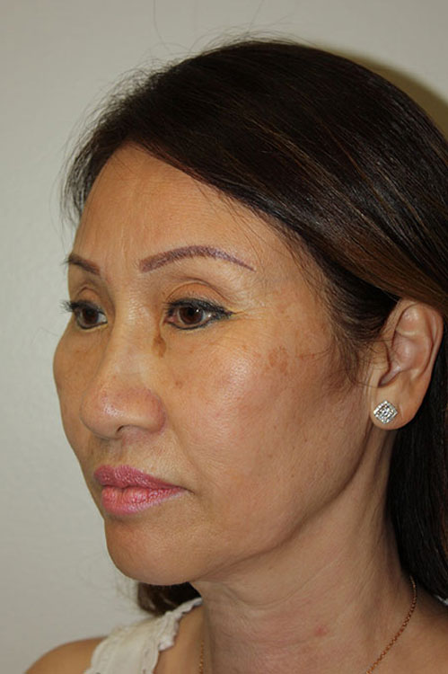 Before & After Patient