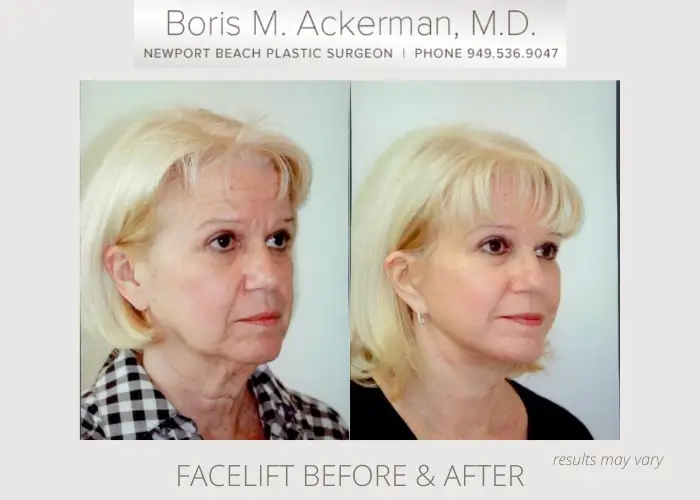 Before and after image showing the results of a facelift performed in Newport Beach, CA.