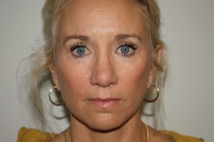 Female Facelift Patient 52 - After - 2 Thumbnail