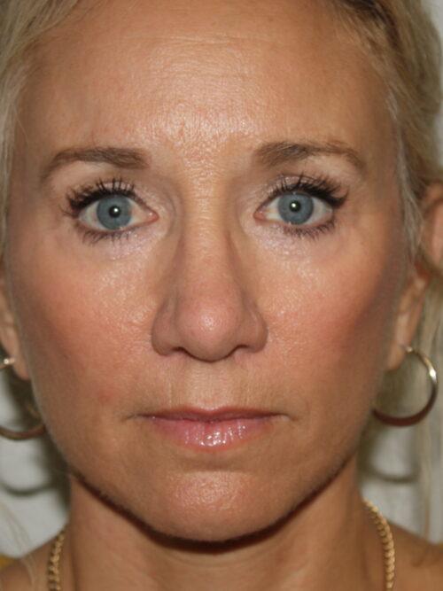 Female Facelift Patient 52 - After - 2